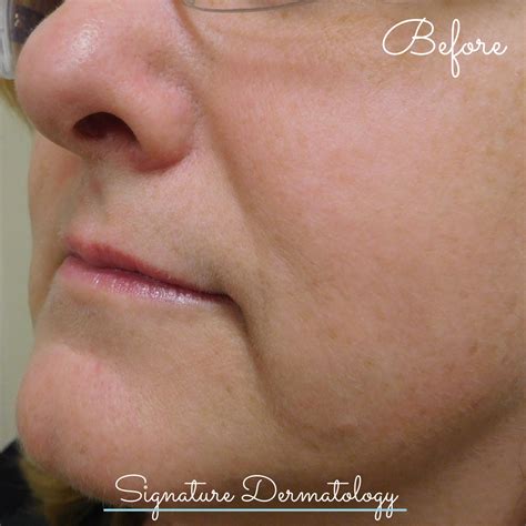 Marionette Lines Before and After | Signature Dermatology