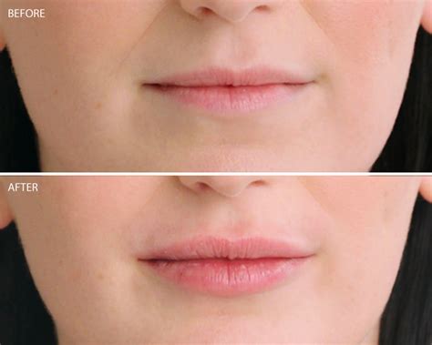 Best Restylane Kysse Lip Filler in Irvine - Natural Looking Volume