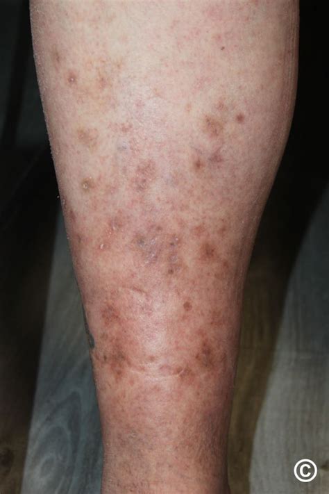 Skin Manifestations Of Diabetes Mellitus Endotext NCBI