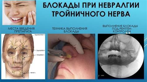 Невралгия тройничного нерва: причины возникновения, симптомы, лечение ...
