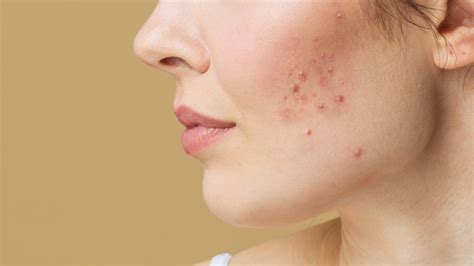 7 Tips To Effectively Deal With Acne-prone Sensitive Skin | Lifestyle News, Times Now