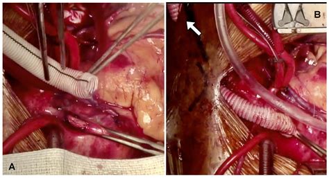 Beating Heart Coronary Artery Bypass Grafting with Preemptive Impella
