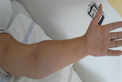 black eschar   region   left arm   ninth day  illness