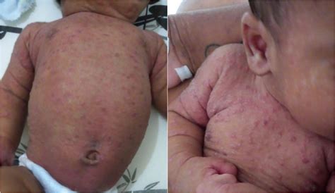 Sarna Humana Em Bebe