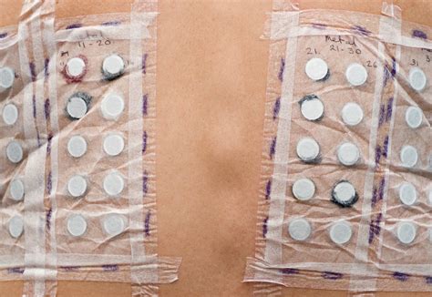 Patch test: teste de contato é importante no diagnóstico de dermatites ...