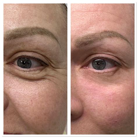 LIPS DUBAI BOTOX COSMETOLOGIST TRAINING КОСМЕТОЛОГ ДУБАЙ ...