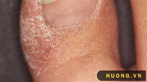 5+ Tác dụng của cây vòi voi ít người biết đến - Hương.Vn