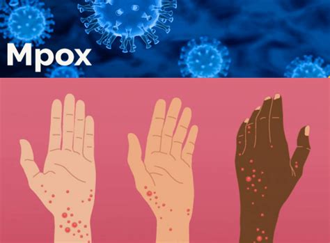 mpox chikin melele