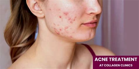 Acne Laser Treatment at Rs 1500/session in Jaipur | ID: 2853996962962