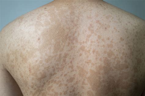tinea versicolor forehead