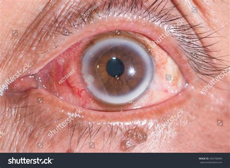 arcus senilis royalty  images stock  pictures