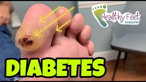 Foot Blisters With Diabetes at Amy Hartzell blog