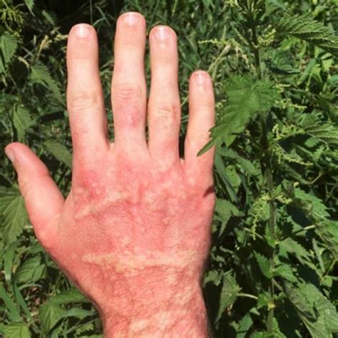 nettle skin rash