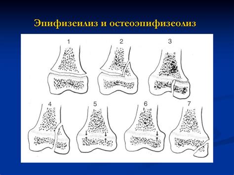 Перелом по типу зеленой ветки: симптомы и лечение