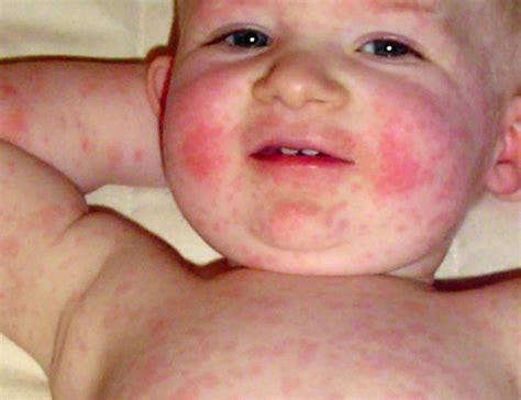 Parvovirus B19 System Disorder Template