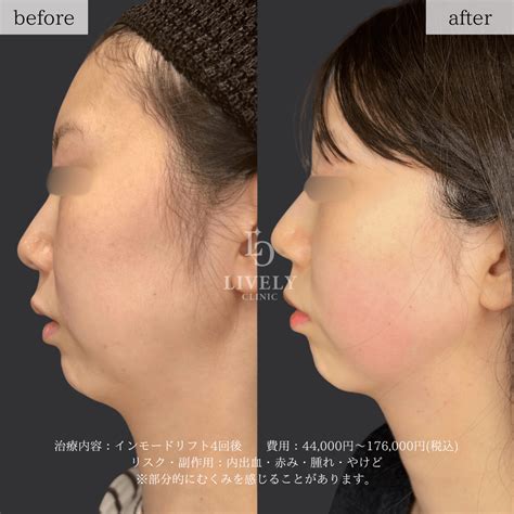 インモードリフト 切らない小顔治療でスッキリリフトアップ | 美容皮膚科･美容整形のライブリークリニック｜LIVELY CLINIC