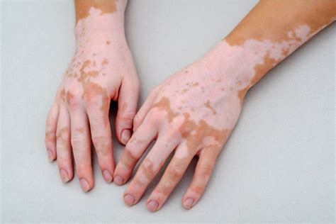 Vitiligo | Warren, OH | Warren Dermatology and Mohs Surgery