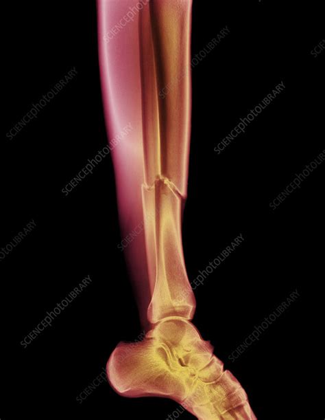 broken leg stock image  science photo library