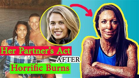 After This Runner Suffered Horrific Third-Degree Burns, Her Partner ...