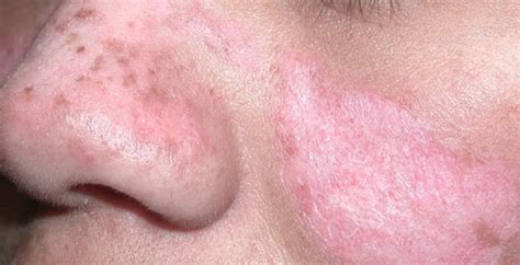 Lupus (kelebek hastalığı) nedir, belirtileri nelerdir? Lupus hastalığı ...