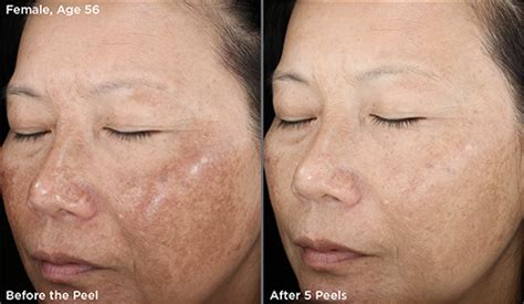 SkinMedica Peels | Refine Medical Aesthetics