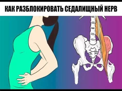 Какие делать упражнения при защемлении седалищного нерва. Защемление ...