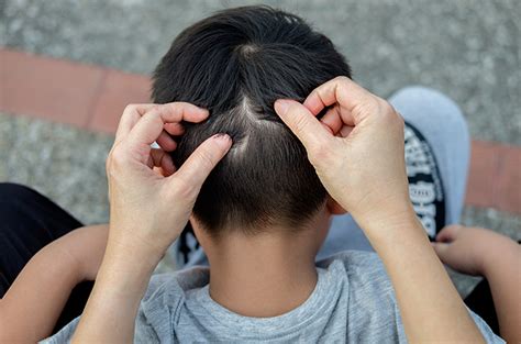menghilangkan telur kutu rambut   menetas