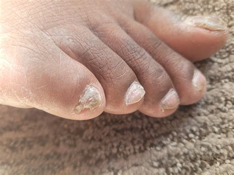 2nd toe nail growing from corner of my pinky toe. : r/notinteresting