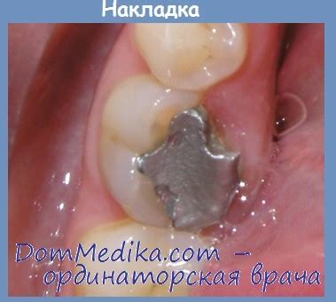 Накладки для восстановления зубов - типы, плюсы и минусы