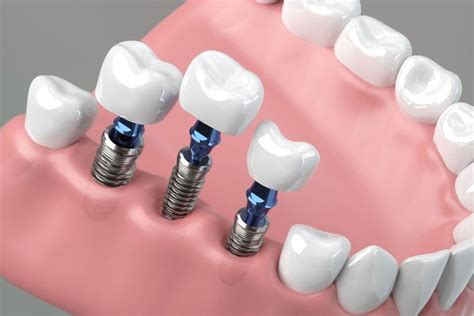 How Many Teeth Can Dental Implants Replace? — Radiant Exceptional Dentistry