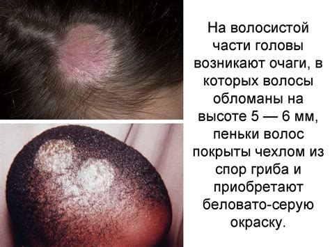Микроспория - презентация онлайн