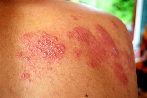 Herpes Zoster Treatment in Pakistan – Pain Relief & Soothing Creams