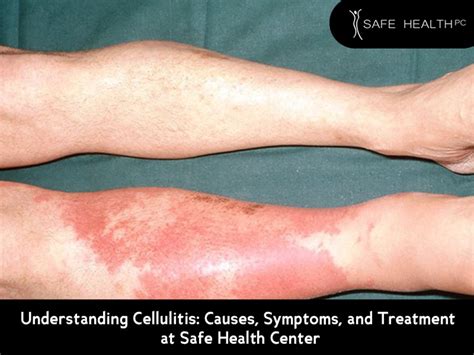 understanding cellulitis causessymptoms  treatment  safe health