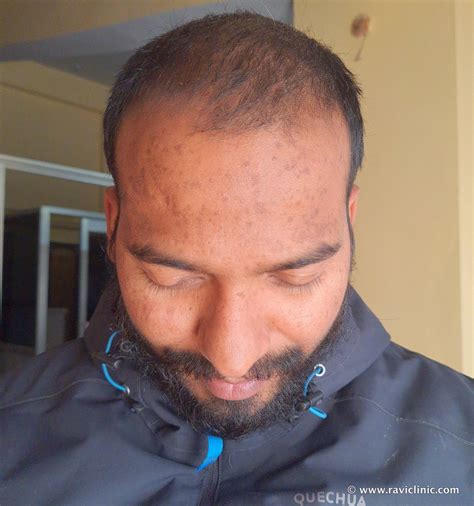 Flat Warts (Verruca Plana) for 10 Years Got cured in an online patient