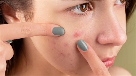 ultimate guide  helping acne scars fade quickly glowsly