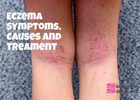 [10000印刷√] eczema causes 129239-Eczema causes and treatment