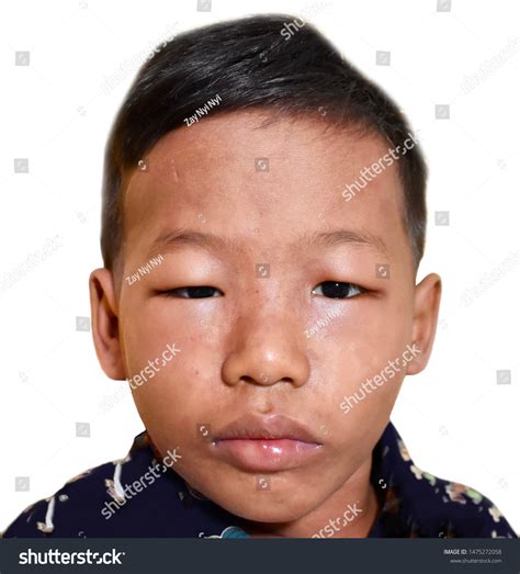 Angioedema Eyelids Lips Southeast Asian Male Stock Photo 1475272058