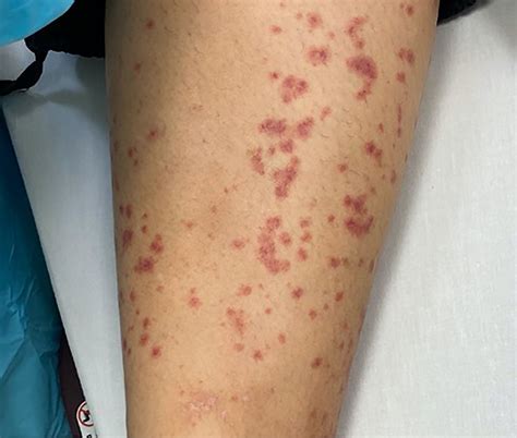 Vascular Rash