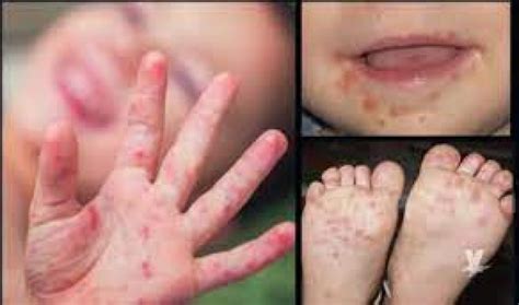 Corrientes en el aire - Virus coxsackie en niños: qué es y cómo se contagia
