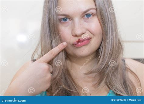Herpes Sulle Labbra Di Una Ragazza. Giovane Donna Con Il Virus Dell ...