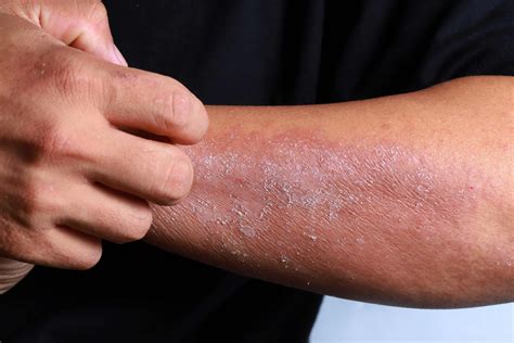 Lichen Simplex vs Normal Eczema - Treatment with Chinese Medicine