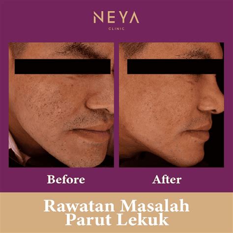 dermapen treatment malaysia aesthetic clinic neya clinic