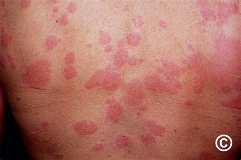 Urticaria Treatment