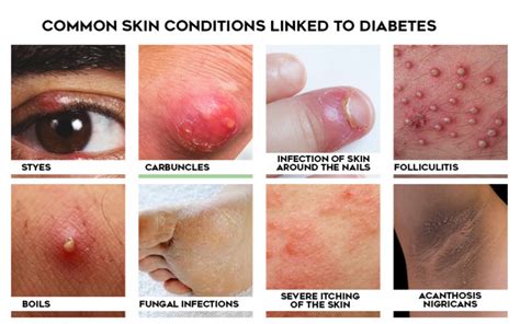 Diabetic Dermopathy, Diabetes Itching Skin Treatment | Sugar Knocker