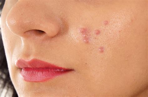 How To Heal Papules - Economicsprogress5