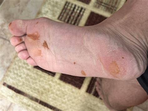 tinea nigra or something else? : r/medical