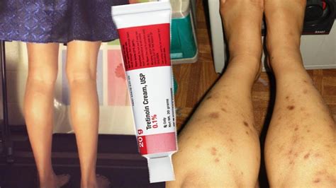 How to get rid of dark spots on legs using chemical peel or tretinoin ...