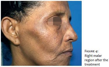 Surgical & Cosmetic Dermatology | Exogenous ochronosis treated with CO2 Laser