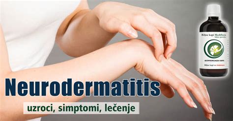 Neurodermatitis - uzroci, simptomi, lečenje - Mediflora