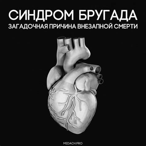 Синдром Бругада – загадочная причина внезапной смерти